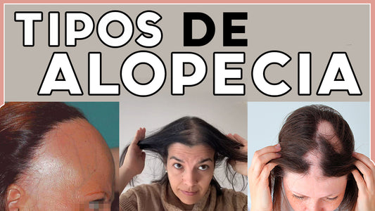 Tipos de Alopecia